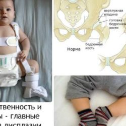 Лечение врожденного вывиха тазобедренного сустава у детей