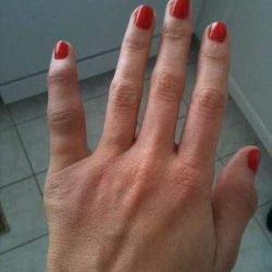 Не сгибается указательный палец после вывиха