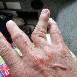 Первая помощь при вывихе большого пальца на руке