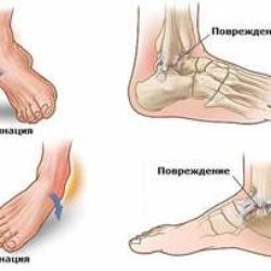 Что делать при ушибах и растяжениях ноги в домашних условиях?
