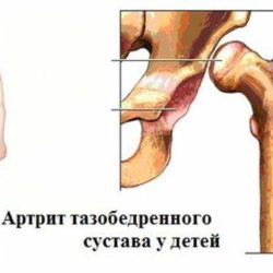 Наложение шины при вывихе плечевого сустава