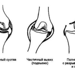Ваши действия при вывихе сустава у занимающегося