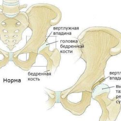 Вывих бедра у детей с дцп что делать