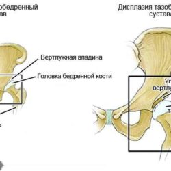 Вывих тазобедренного сустава у новорожденных лечение