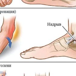 Повреждение голеностопного сустава вывих или разрыв связок