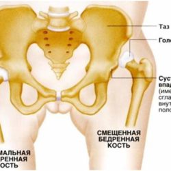 Вывих тазобедренного сустава лечение в домашних условиях