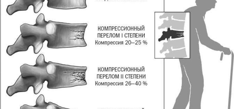 Почему после перелома позвоночника не могут ходить?