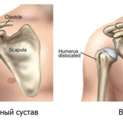 Какую первую помощь нужно оказать человеку при вывихе?