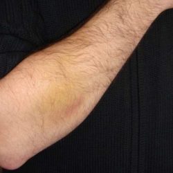Оказание первой медицинской помощи при ушибе предплечья