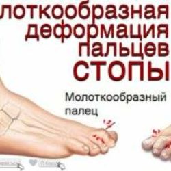 Операция при вывихах и молоткообразных деформациях пальцев стоп операция гомана