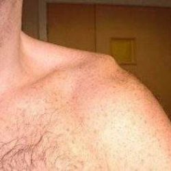 Неотложная помощь при вывихе плечевого сустава
