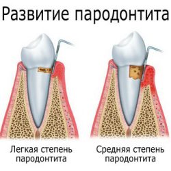 Лечение пародонтоза
