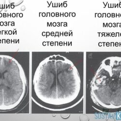 Ушиб головного мозга легкой степени у грудничка последствия