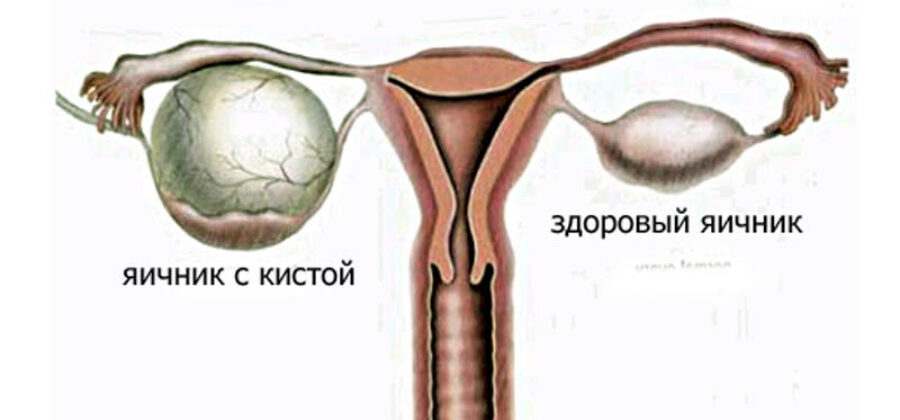 Что из себя представляет фолликулярная киста яичника?