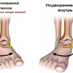 Сколько держится отек при растяжении связок голеностопного сустава