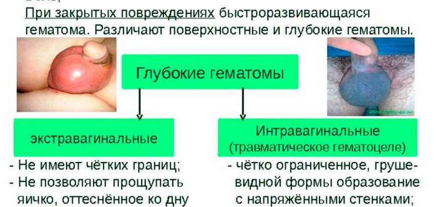 Ушиб яичка у мужчин лечение в домашних условиях