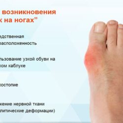 Воспаление косточки на ноге и отек поверхности